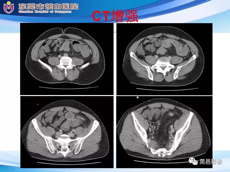 影像PPT - 【PPT】腹茧症的影像诊断-16