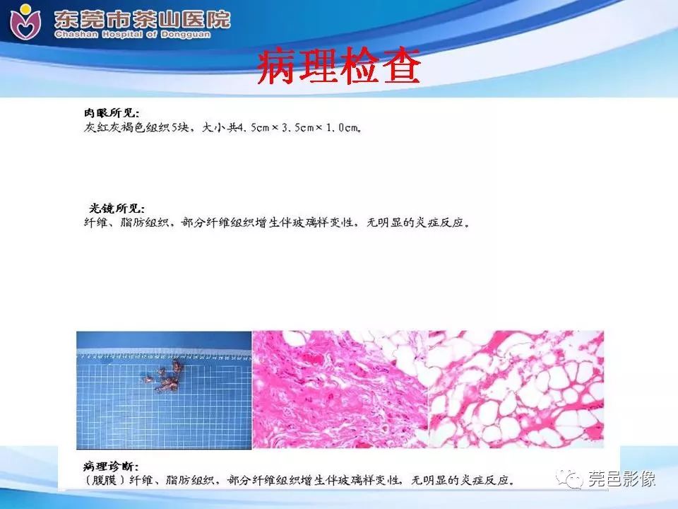 影像PPT - 【PPT】腹茧症的影像诊断-21