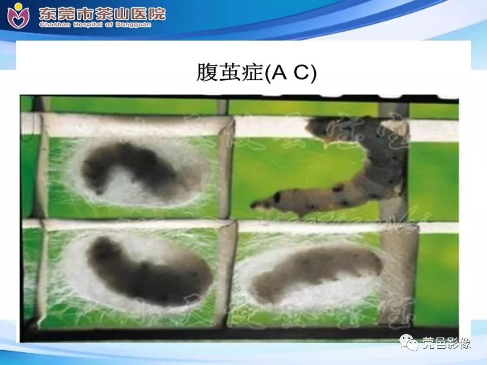 影像PPT - 【PPT】腹茧症的影像诊断-23