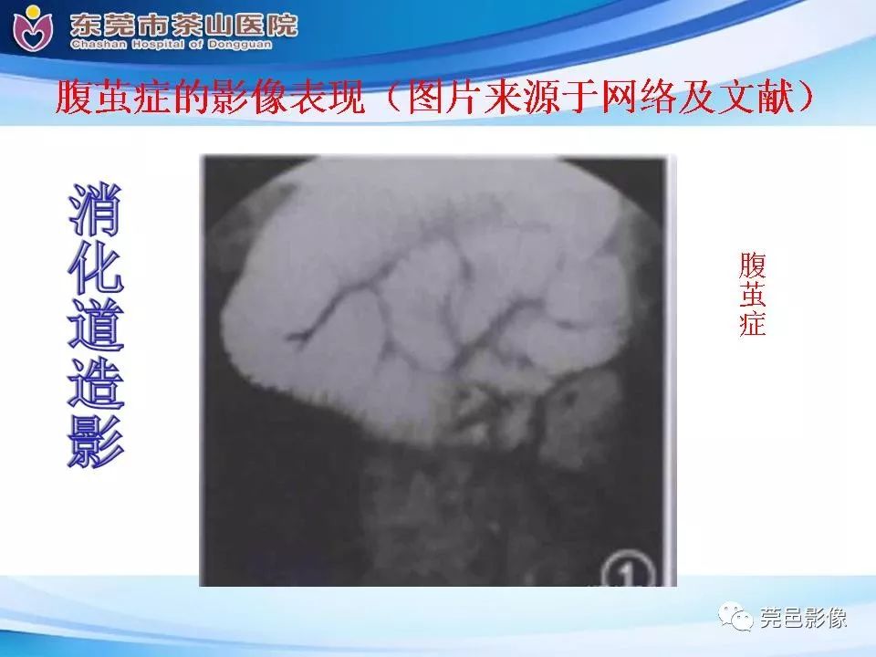 影像PPT - 【PPT】腹茧症的影像诊断-31