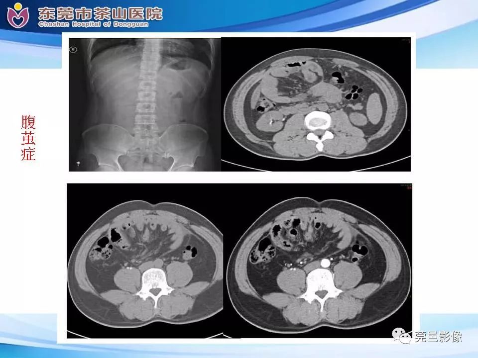 影像PPT - 【PPT】腹茧症的影像诊断-32