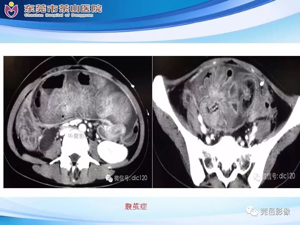 影像PPT - 【PPT】腹茧症的影像诊断-37