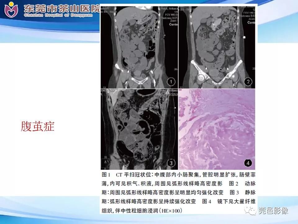 影像PPT - 【PPT】腹茧症的影像诊断-38