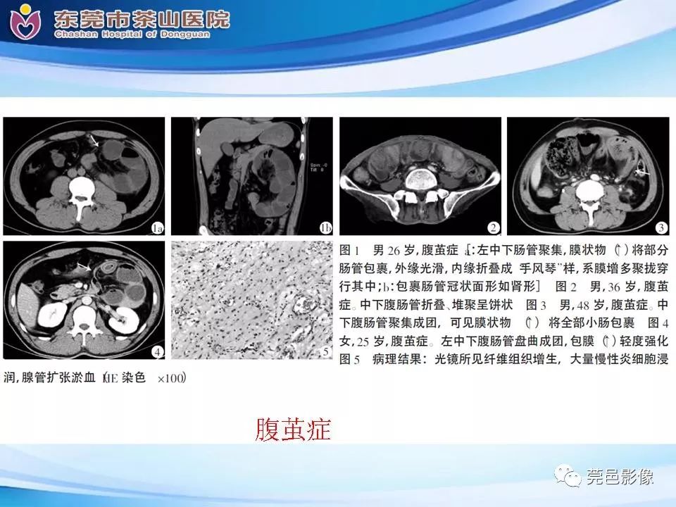 影像PPT - 【PPT】腹茧症的影像诊断-40