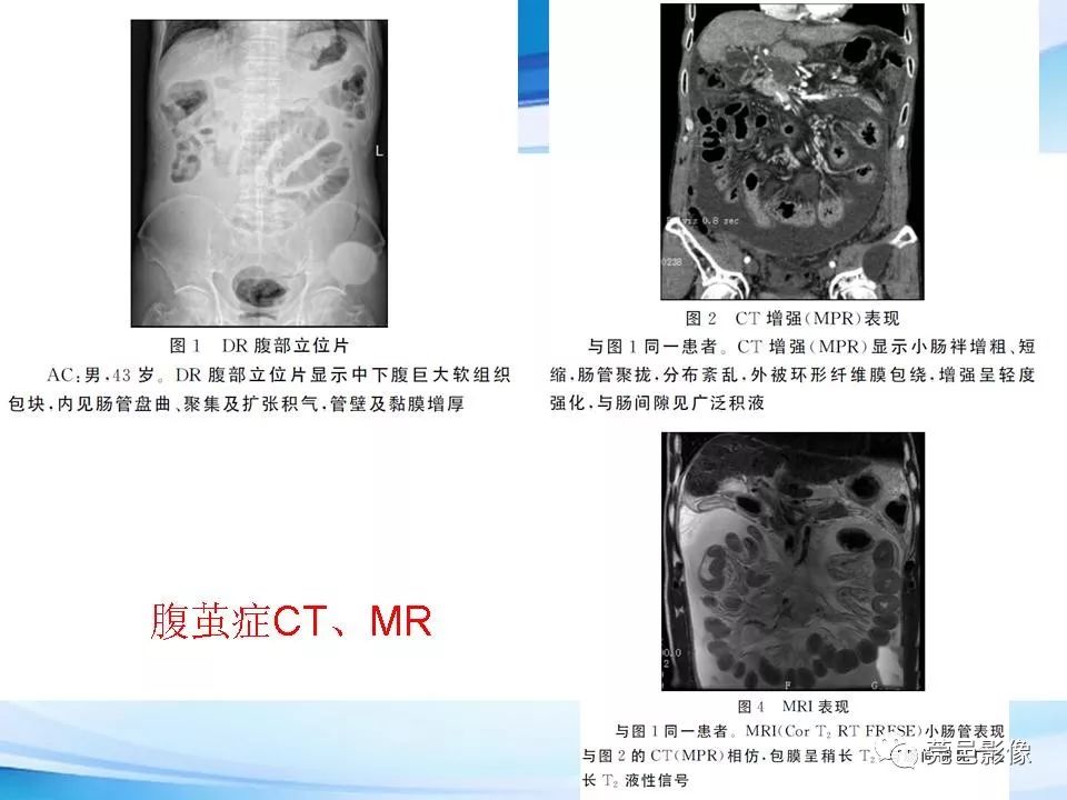 影像PPT - 【PPT】腹茧症的影像诊断-42