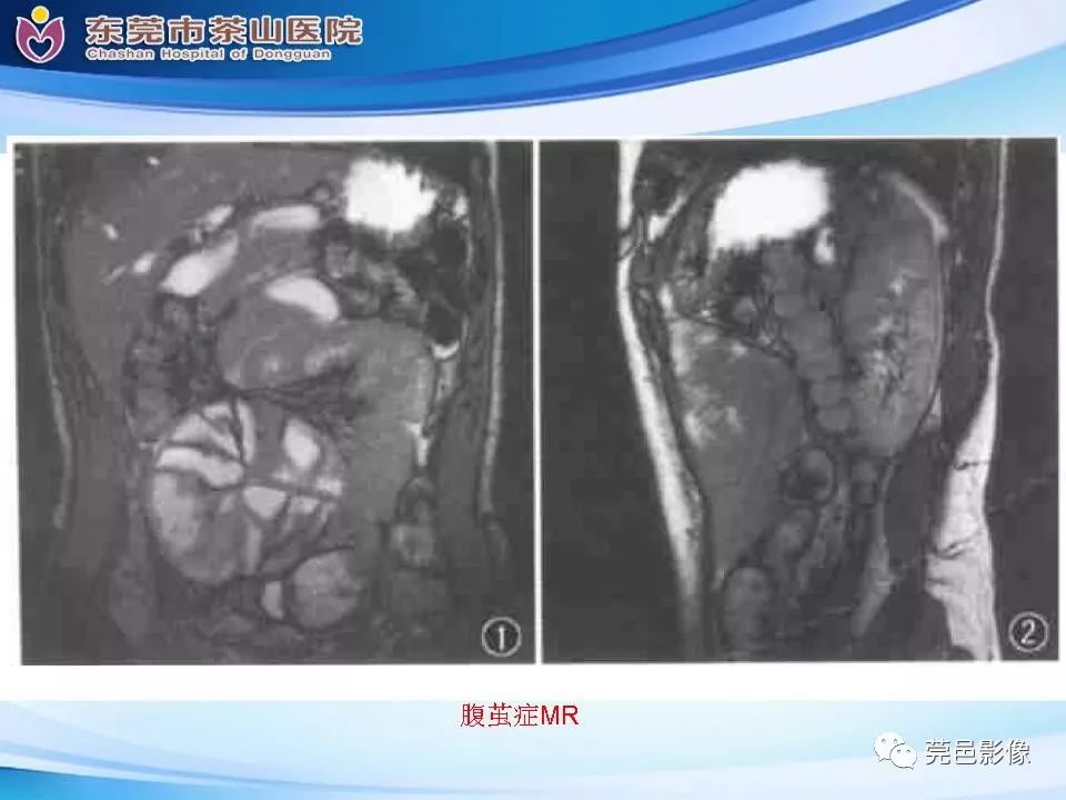 影像PPT - 【PPT】腹茧症的影像诊断-43