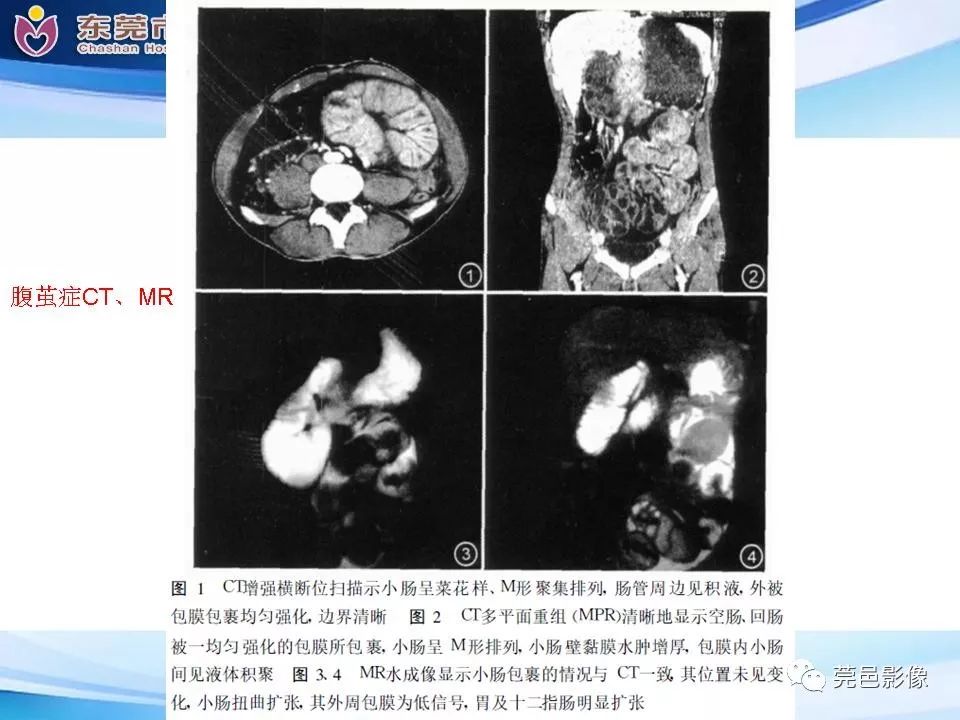 影像PPT - 【PPT】腹茧症的影像诊断-44