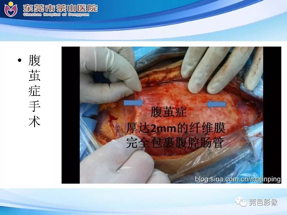 影像PPT - 【PPT】腹茧症的影像诊断-45