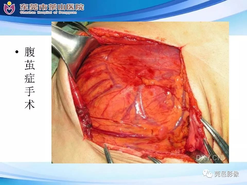 影像PPT - 【PPT】腹茧症的影像诊断-46