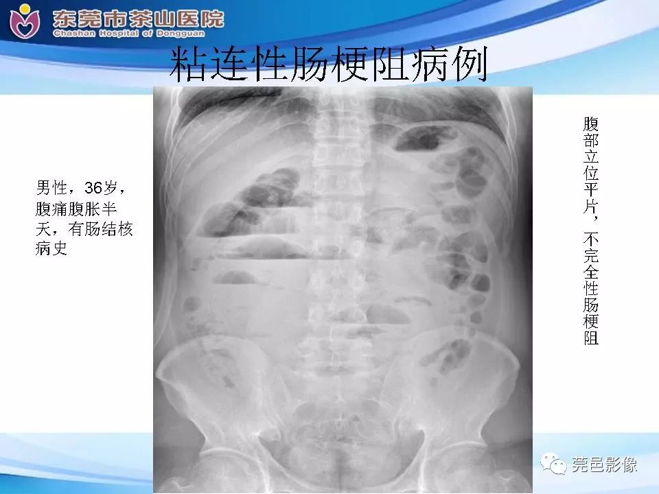 影像PPT - 【PPT】腹茧症的影像诊断-49
