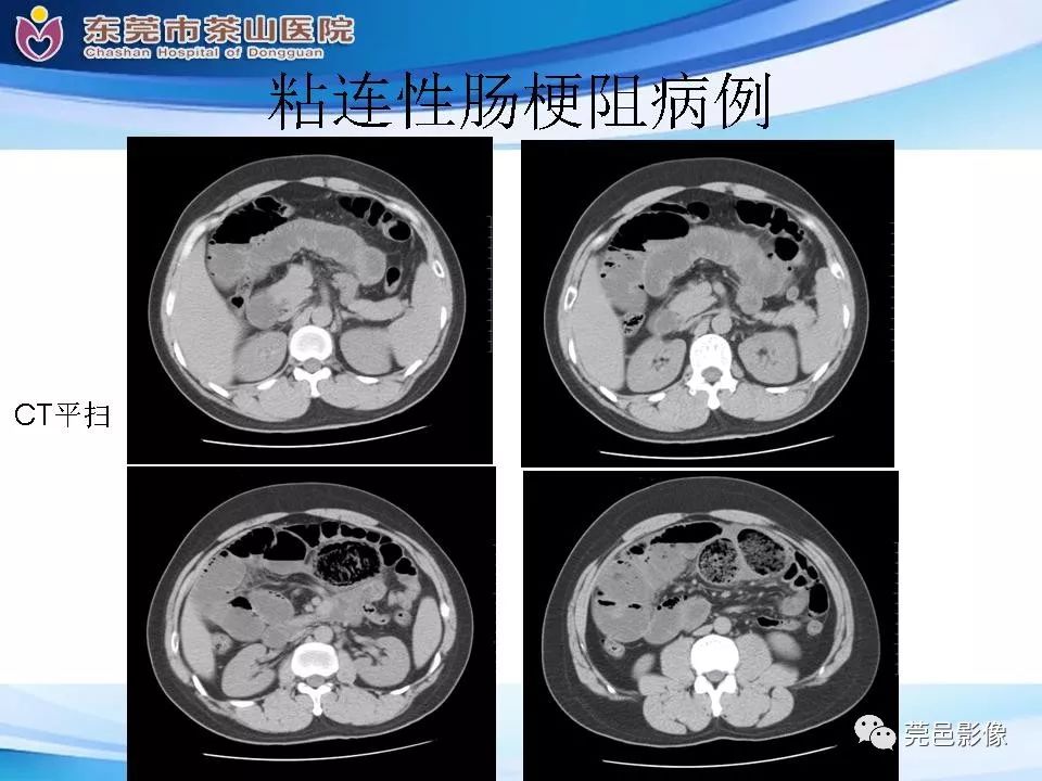 影像PPT - 【PPT】腹茧症的影像诊断-50
