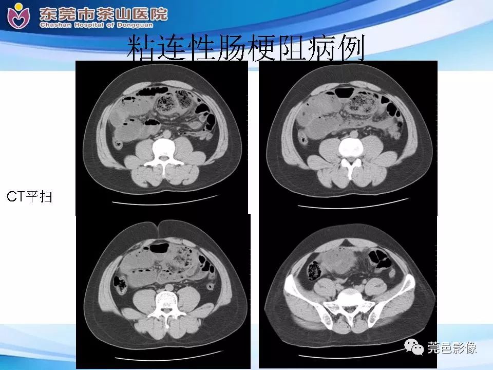 影像PPT - 【PPT】腹茧症的影像诊断-51