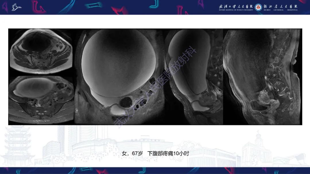 影像PPT - 【PPT】盆腹腔巨大占位性病变影像诊断-3