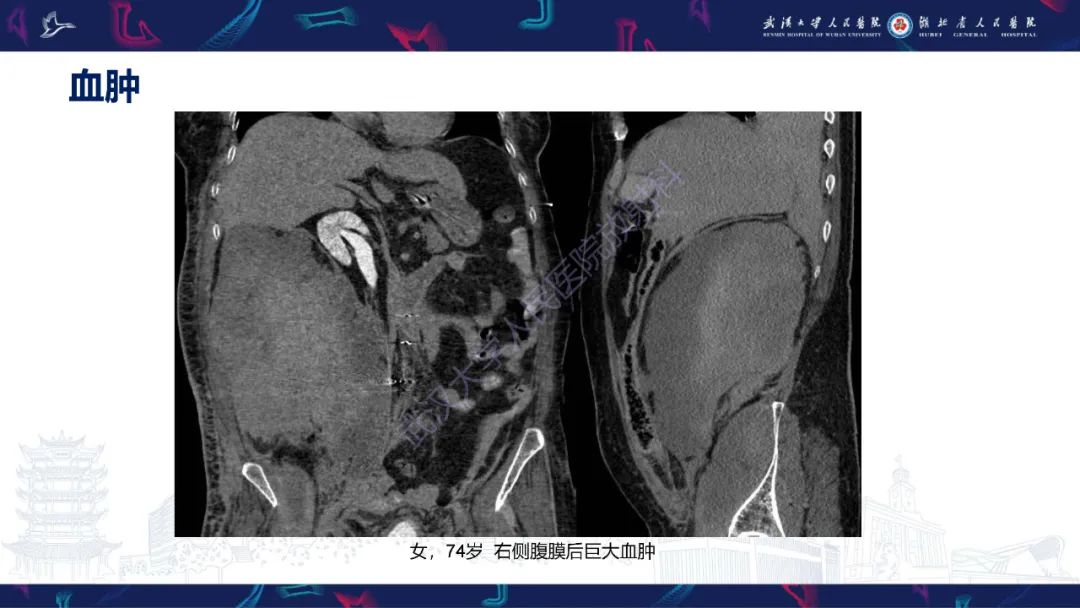 影像PPT - 【PPT】盆腹腔巨大占位性病变影像诊断-7