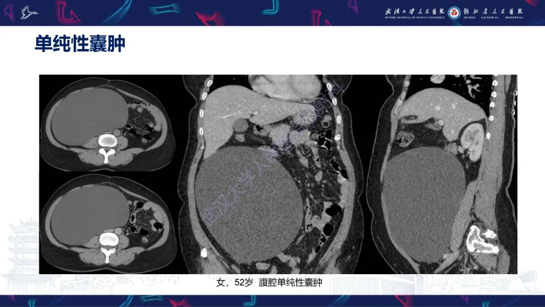 影像PPT - 【PPT】盆腹腔巨大占位性病变影像诊断-8