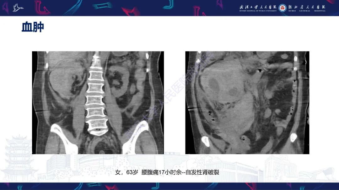 影像PPT - 【PPT】盆腹腔巨大占位性病变影像诊断-9