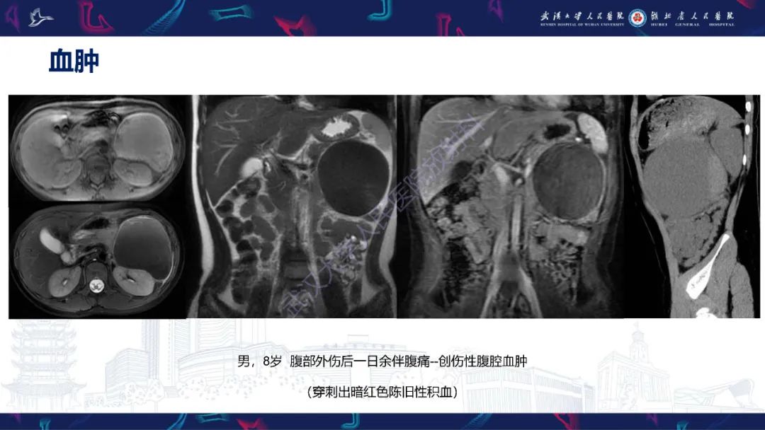 影像PPT - 【PPT】盆腹腔巨大占位性病变影像诊断-10