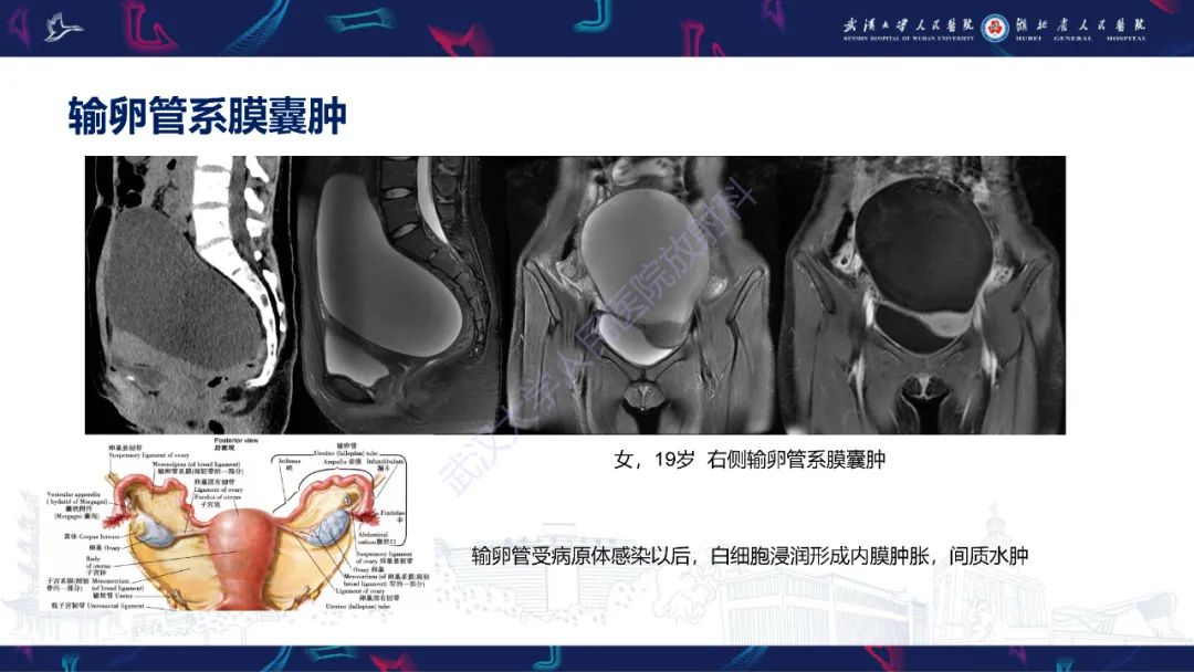 影像PPT - 【PPT】盆腹腔巨大占位性病变影像诊断-12