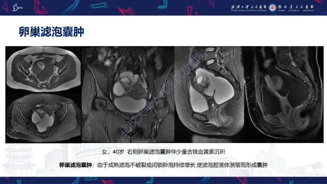 影像PPT - 【PPT】盆腹腔巨大占位性病变影像诊断-13