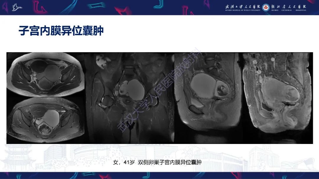 影像PPT - 【PPT】盆腹腔巨大占位性病变影像诊断-14