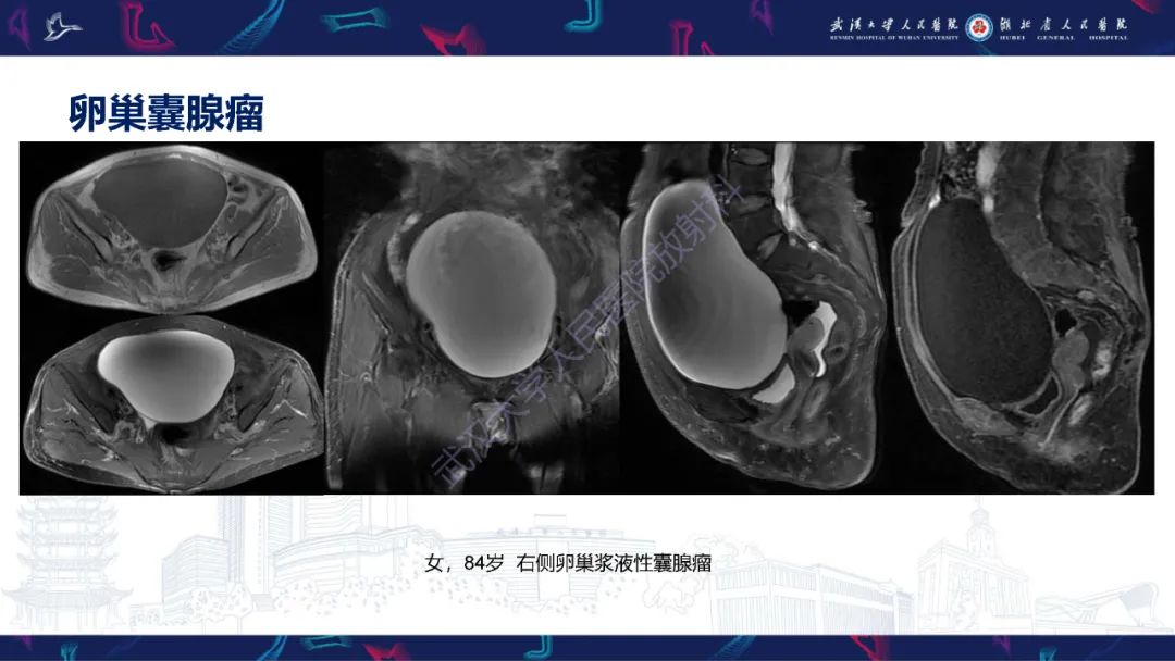 影像PPT - 【PPT】盆腹腔巨大占位性病变影像诊断-15