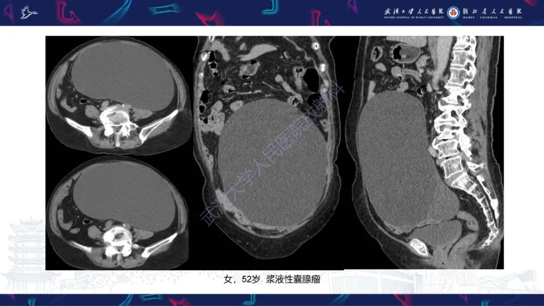 影像PPT - 【PPT】盆腹腔巨大占位性病变影像诊断-16