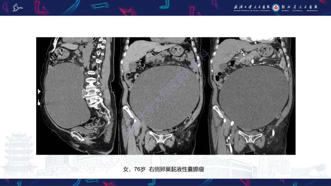 影像PPT - 【PPT】盆腹腔巨大占位性病变影像诊断-17