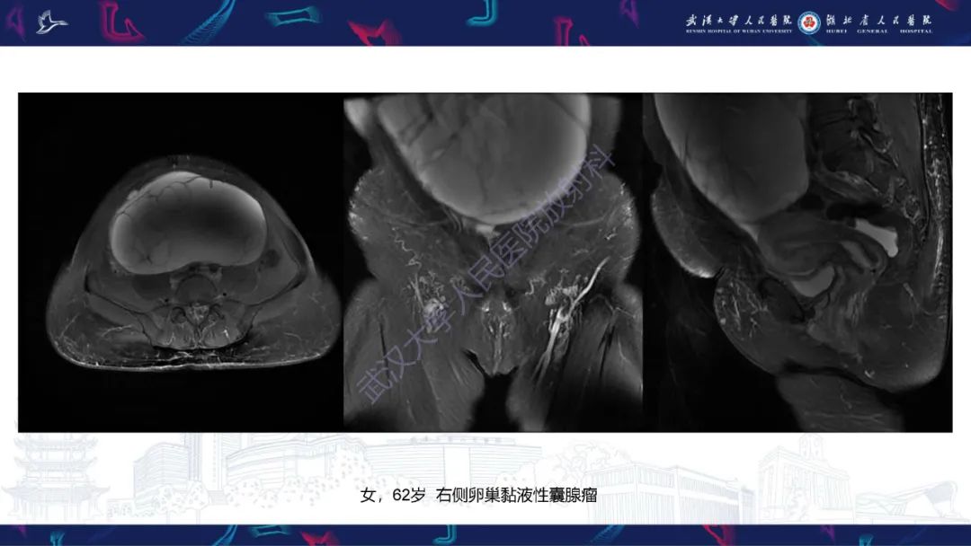 影像PPT - 【PPT】盆腹腔巨大占位性病变影像诊断-18