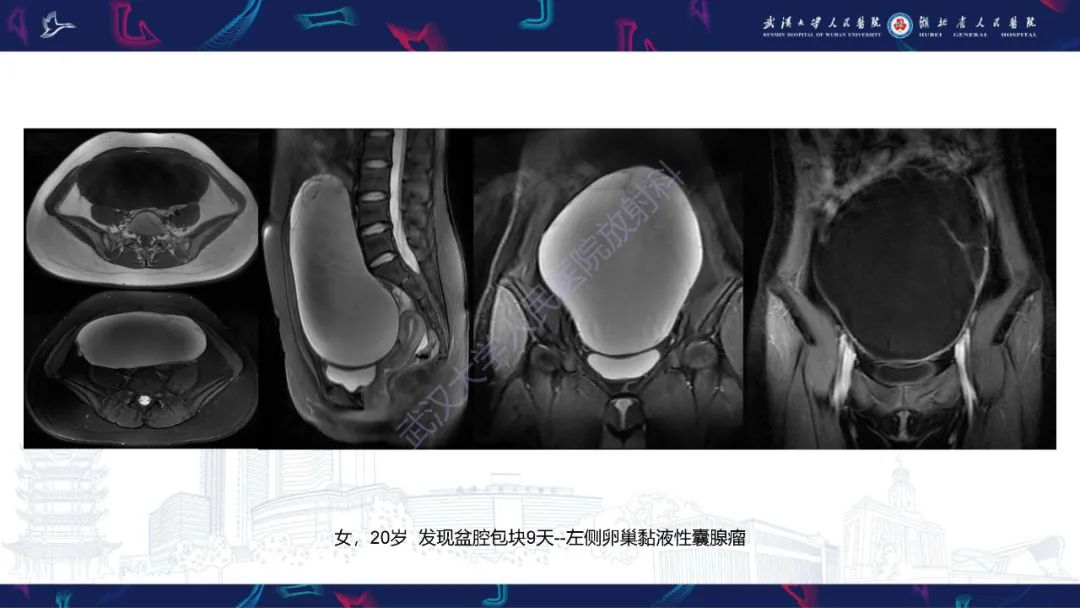 影像PPT - 【PPT】盆腹腔巨大占位性病变影像诊断-19