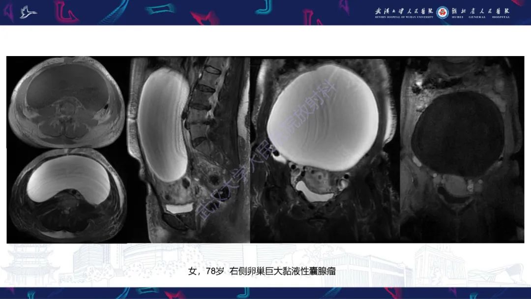 影像PPT - 【PPT】盆腹腔巨大占位性病变影像诊断-20