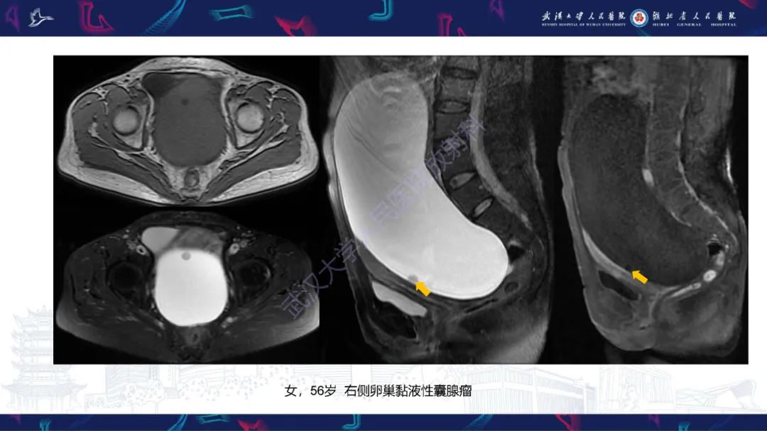 影像PPT - 【PPT】盆腹腔巨大占位性病变影像诊断-21