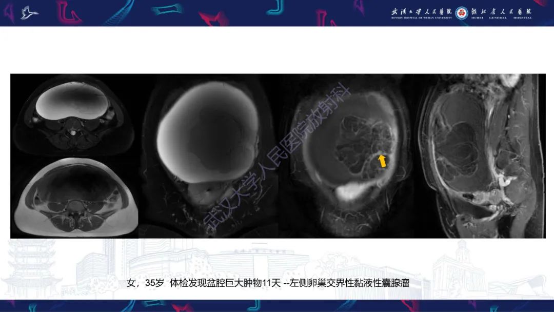 影像PPT - 【PPT】盆腹腔巨大占位性病变影像诊断-23