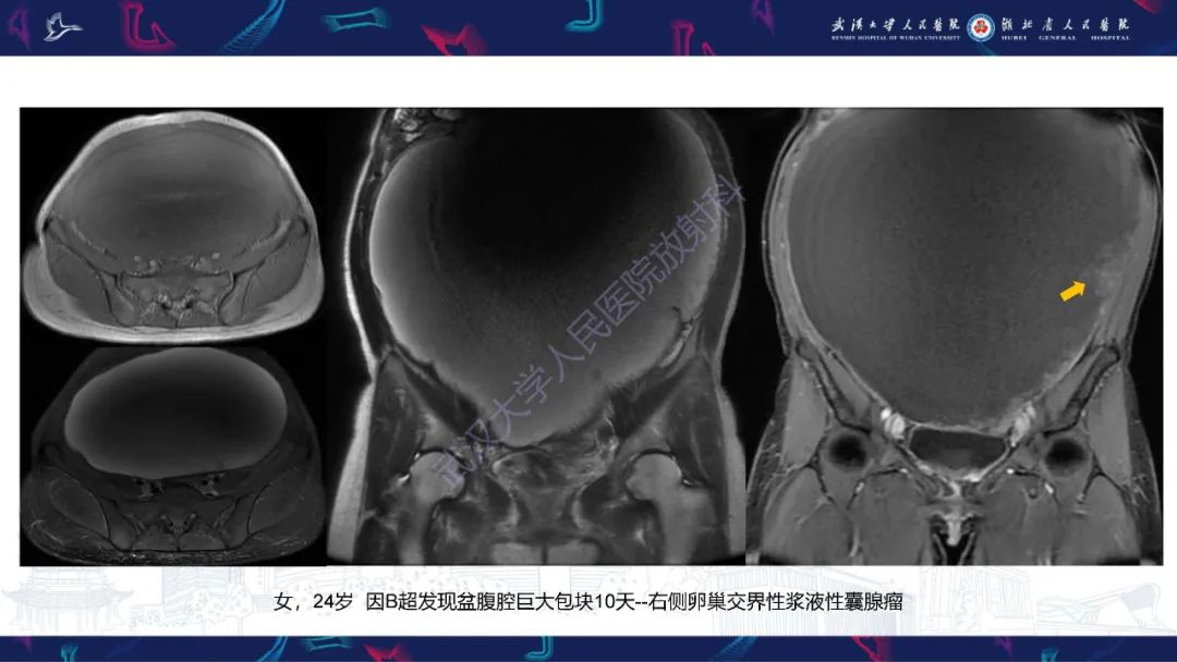 影像PPT - 【PPT】盆腹腔巨大占位性病变影像诊断-24