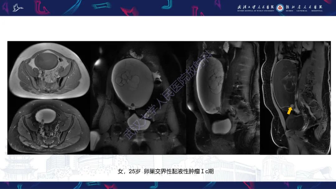 影像PPT - 【PPT】盆腹腔巨大占位性病变影像诊断-25