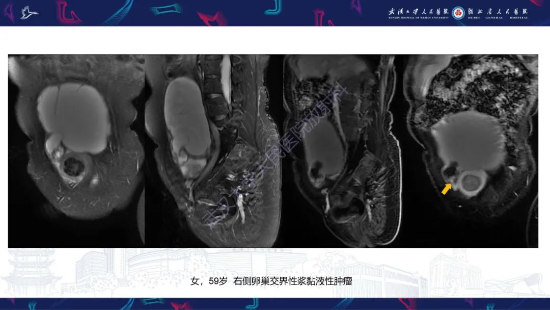 影像PPT - 【PPT】盆腹腔巨大占位性病变影像诊断-26