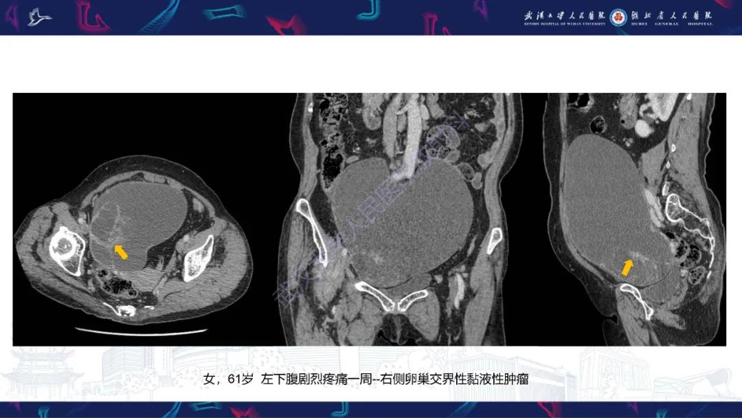 影像PPT - 【PPT】盆腹腔巨大占位性病变影像诊断-27