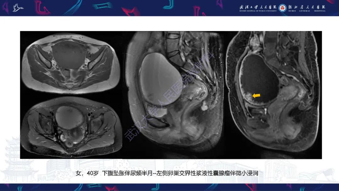 影像PPT - 【PPT】盆腹腔巨大占位性病变影像诊断-28