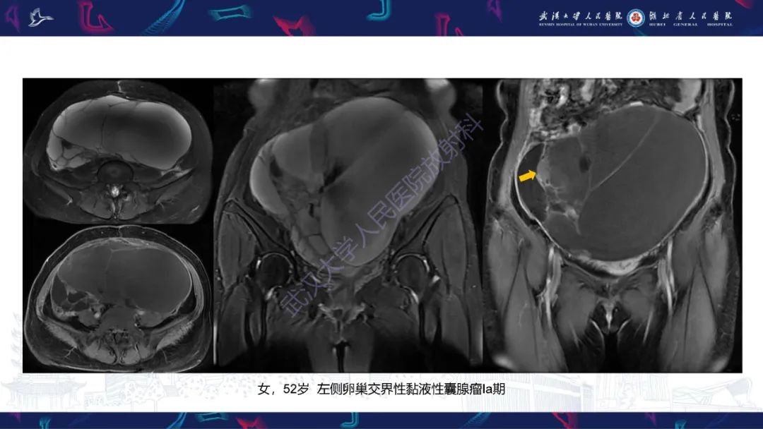 影像PPT - 【PPT】盆腹腔巨大占位性病变影像诊断-30