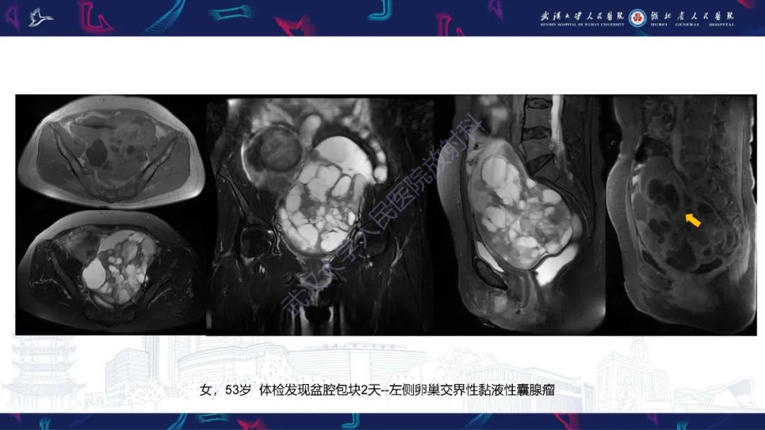 影像PPT - 【PPT】盆腹腔巨大占位性病变影像诊断-31