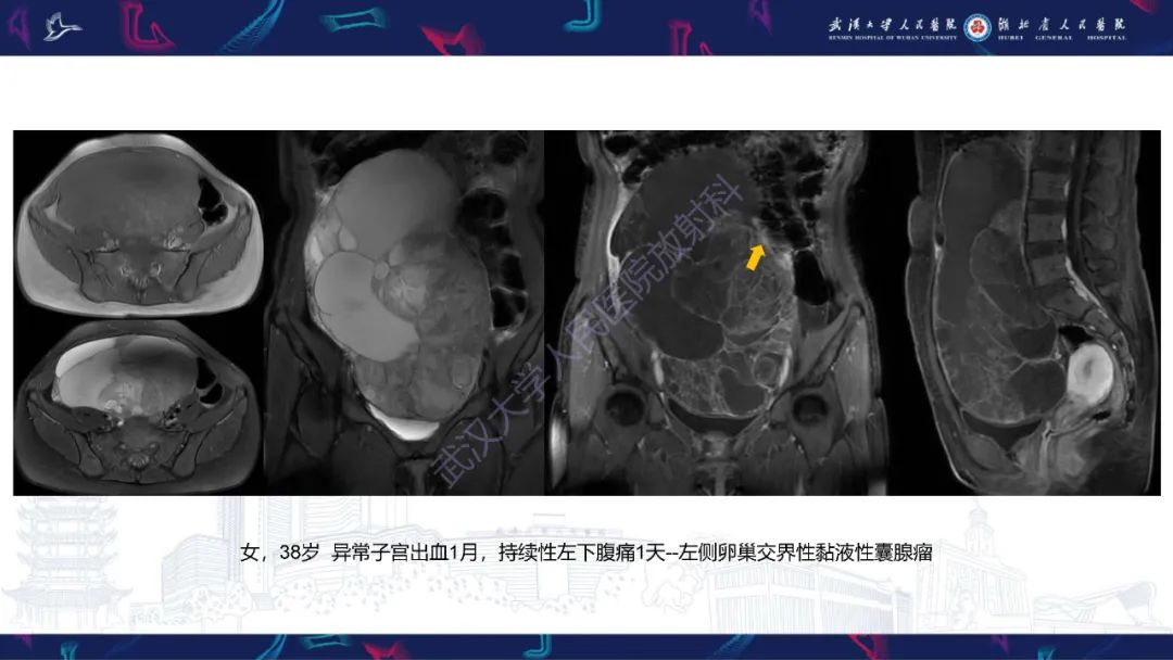 影像PPT - 【PPT】盆腹腔巨大占位性病变影像诊断-29