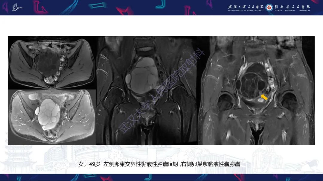 影像PPT - 【PPT】盆腹腔巨大占位性病变影像诊断-32