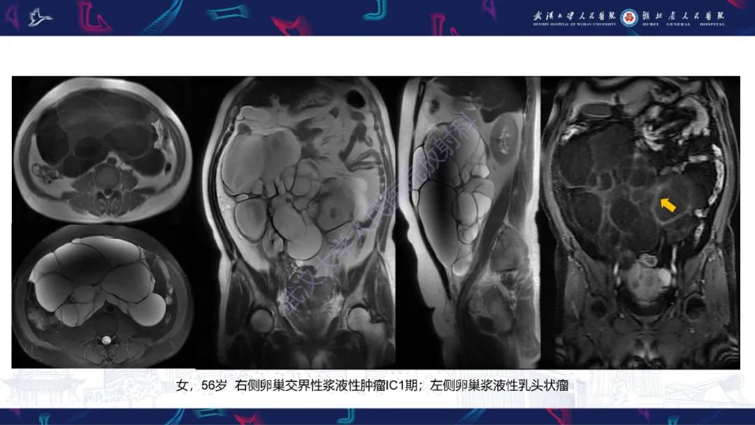 影像PPT - 【PPT】盆腹腔巨大占位性病变影像诊断-33