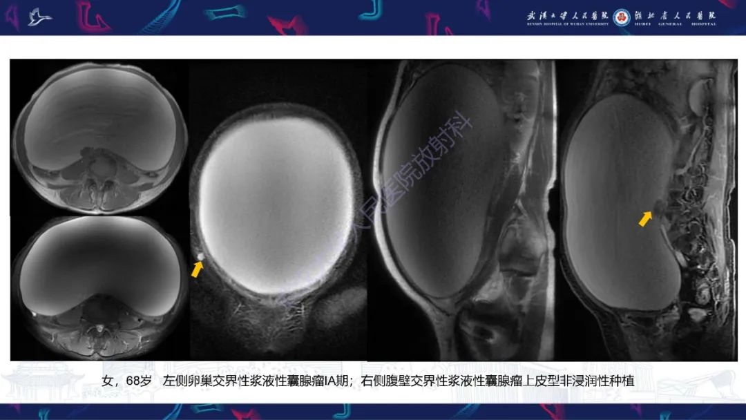 影像PPT - 【PPT】盆腹腔巨大占位性病变影像诊断-34