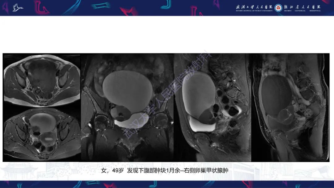 影像PPT - 【PPT】盆腹腔巨大占位性病变影像诊断-36