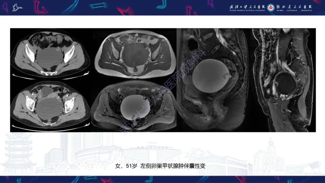 影像PPT - 【PPT】盆腹腔巨大占位性病变影像诊断-37