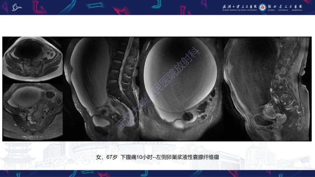 影像PPT - 【PPT】盆腹腔巨大占位性病变影像诊断-39
