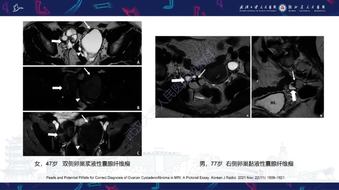 影像PPT - 【PPT】盆腹腔巨大占位性病变影像诊断-40
