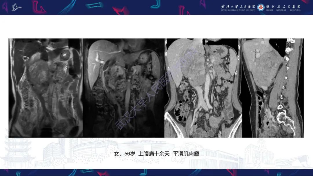 影像PPT - 【PPT】盆腹腔巨大占位性病变影像诊断-43