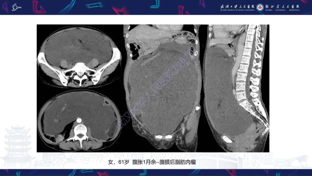 影像PPT - 【PPT】盆腹腔巨大占位性病变影像诊断-44