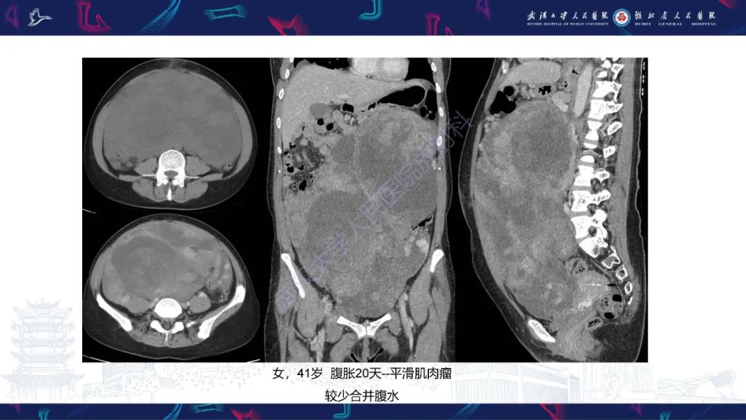 影像PPT - 【PPT】盆腹腔巨大占位性病变影像诊断-45